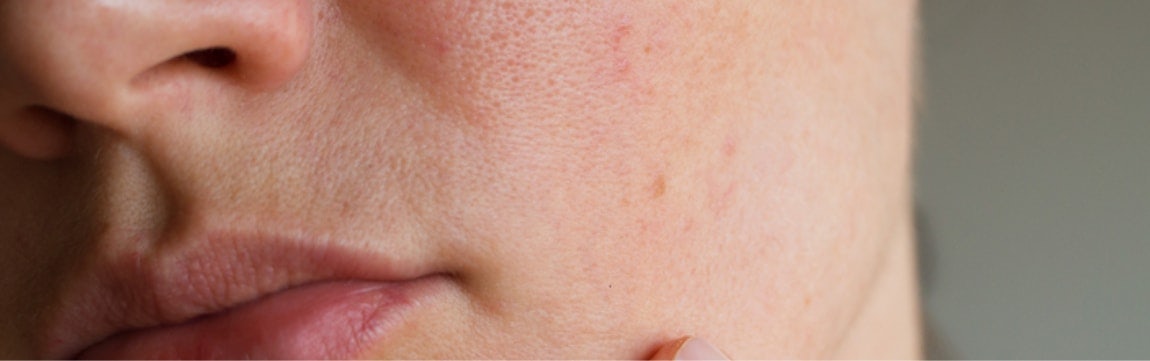 What Causes Adult Acne? Symptoms and Acne Treatments